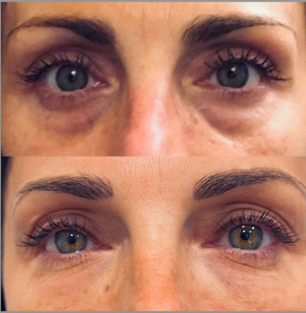 Before - Increases collagen production